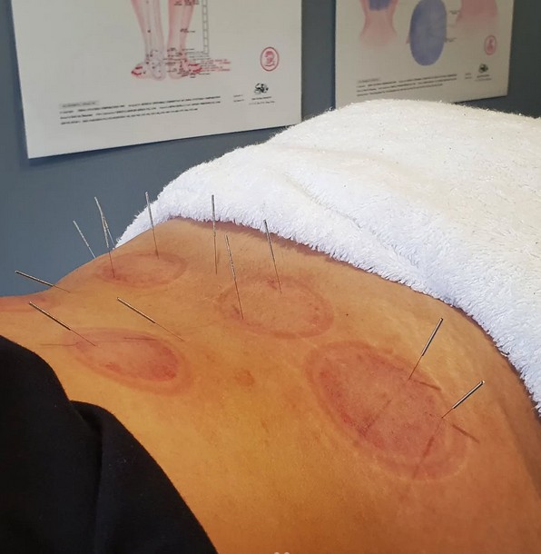 Cupping therapy process