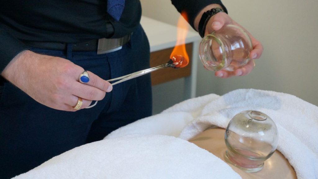 Cupping Therapy: Unlock Healing Benefits in Melbourne