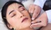 Cosmetic Acupuncture: Important Drawbacks to Be Aware Of